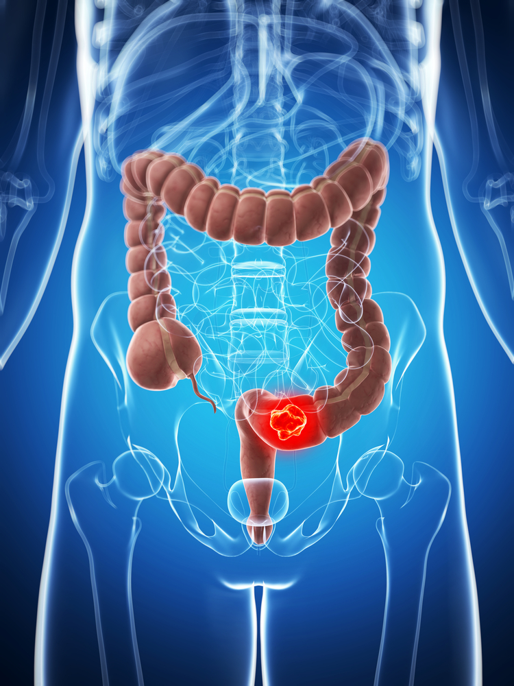 Treatment of colorectal cancer and metostaz in the liver Treatment of colorectal cancer and metostaz in the liver